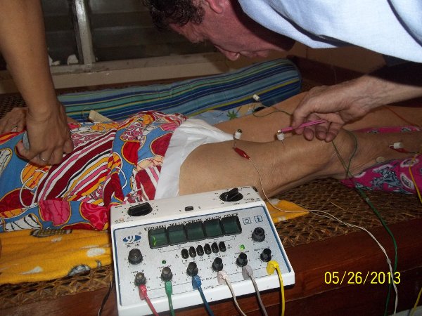 acupuncture with tens machine and moxybunction